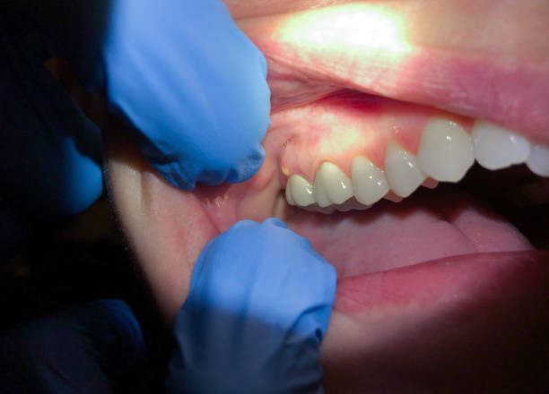 Best Emergency Root Canal Treatment in Salem, UT